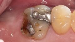 Preparación, tallado del molar para dar espacio para el metal y porcelana
