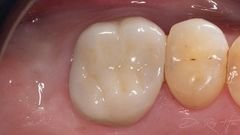 Corona de molar cementada