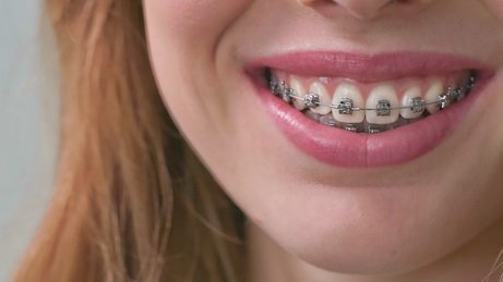 Ortodoncia brackets autoligado dentalnet